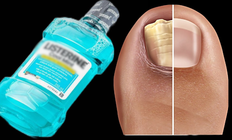 The Surprising Cure for Nail Fungus